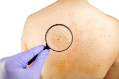Magnifying glass examining skin